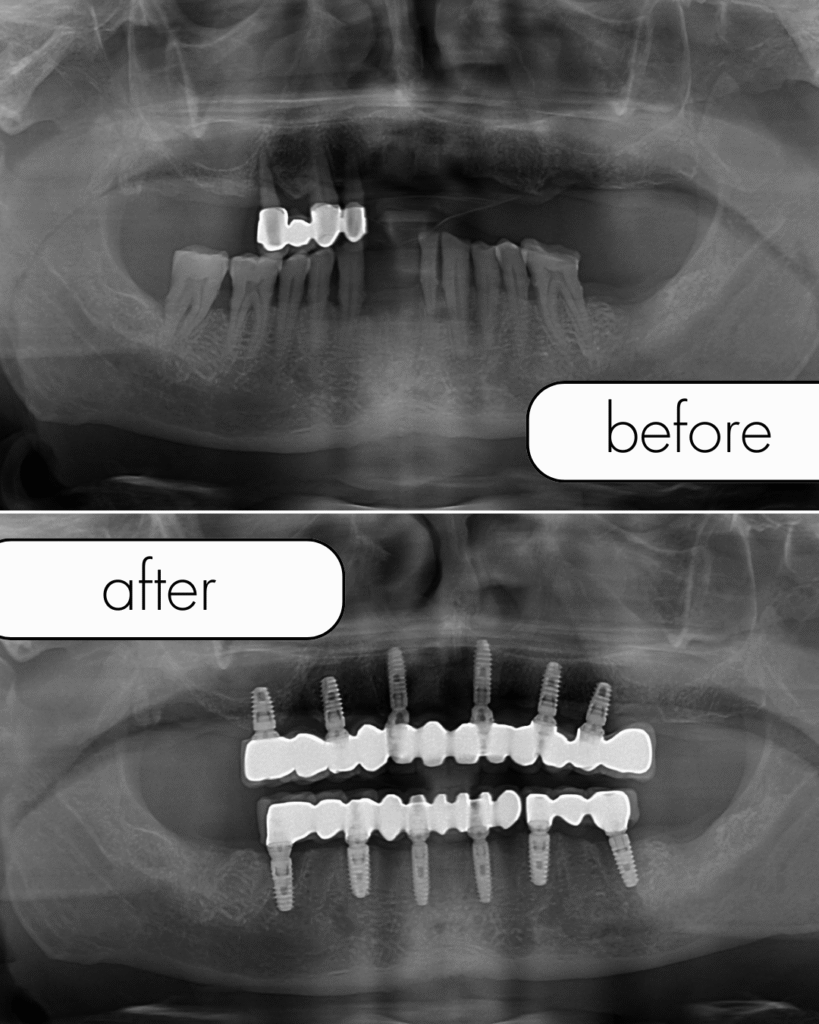 Professional maxillofacial surgeon performing dental implants for health tourism in Antalya, Turkey.