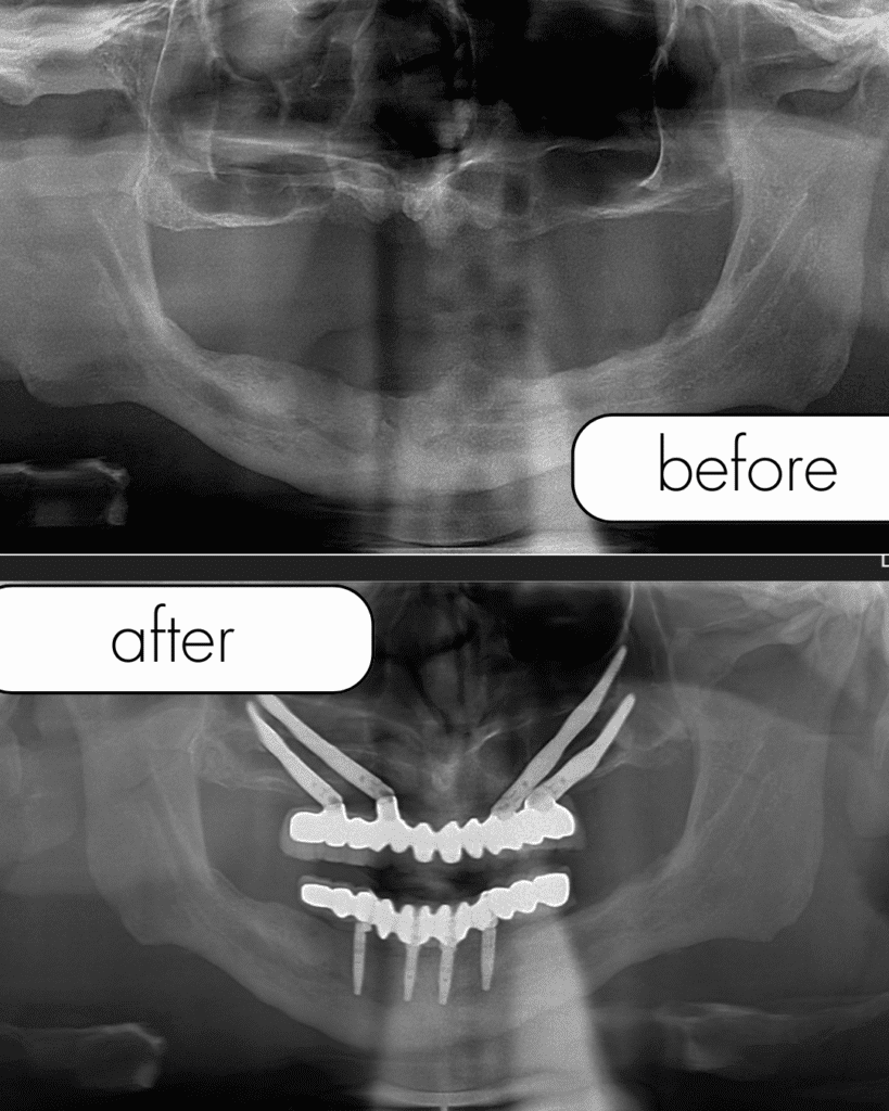 Zygoma implant in Turkey, zygomatic implant