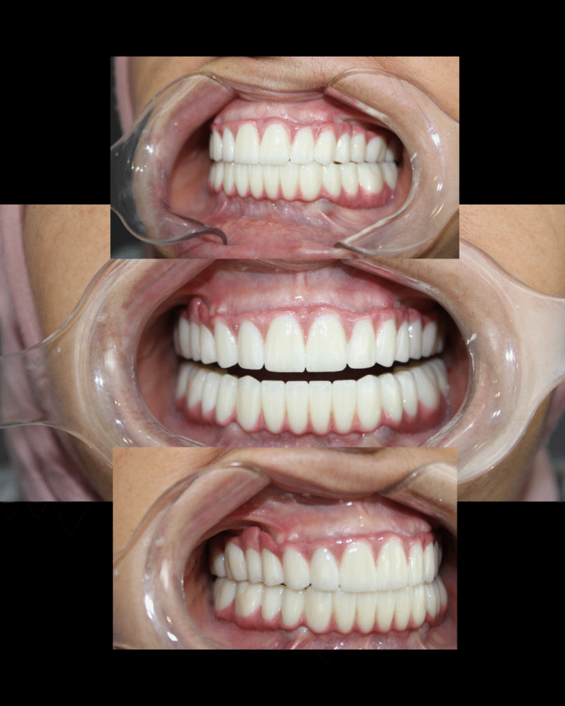 Smile makeover with dental implants in Antalya, Turkey