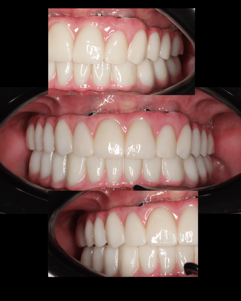 dental implant, ceramic implant