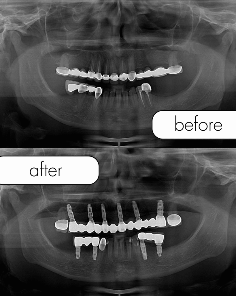 Before and after dental implant results Turkey
