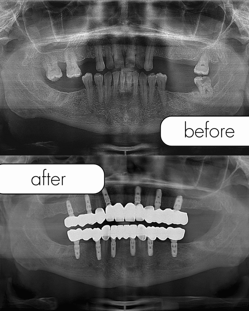 dental implant, ceramic implant, zygoma implant in Turkey