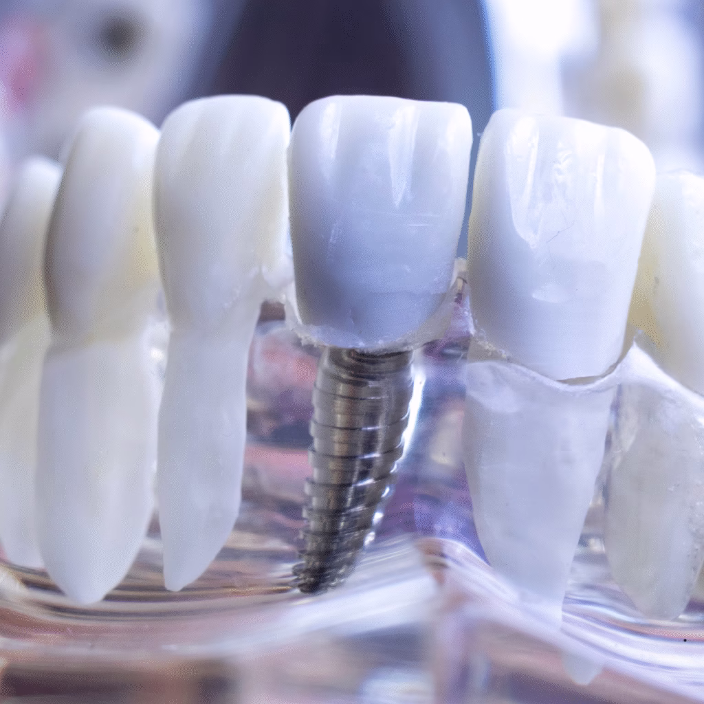 Dental implant Turkey by Dr Osman Akıncı